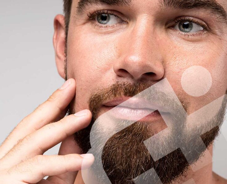 Beard-and-Mustache-Transplantation Beard-and-Mustache-Transplantation