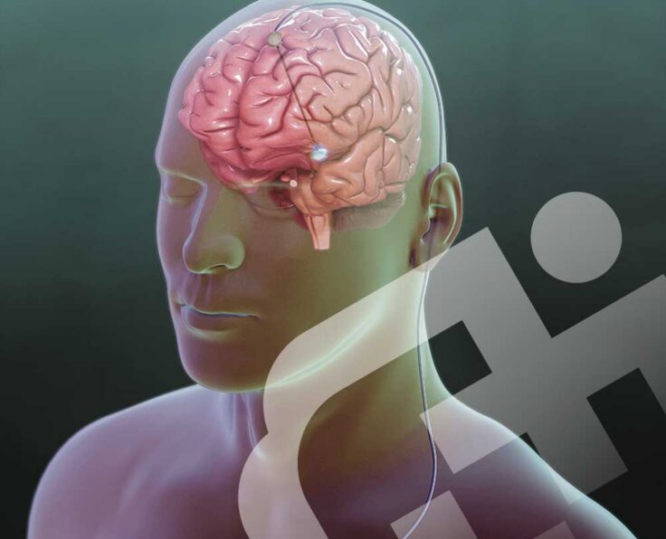Deep-Brain-Stimulation-(DBS)-Surgery