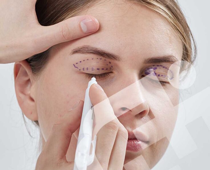 Eyelid Surgery (Blepharoplasty)