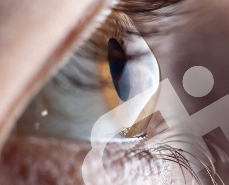 Keratoconus-treatment Keratoconus-treatment