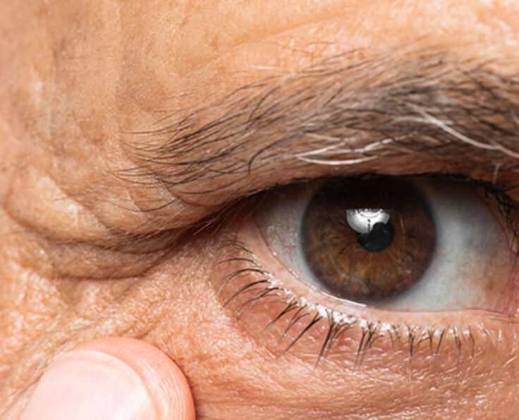 Ptosis-Surgery Ptosis-Surgery